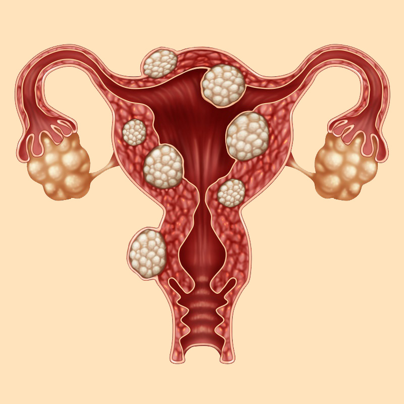 Uterine Fibroid